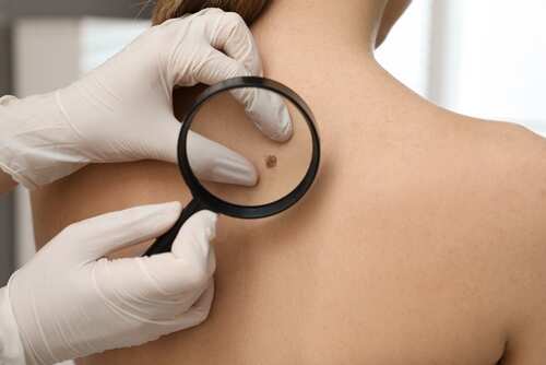A healthcare professional examining a mole on a patient's back with a magnifying glass